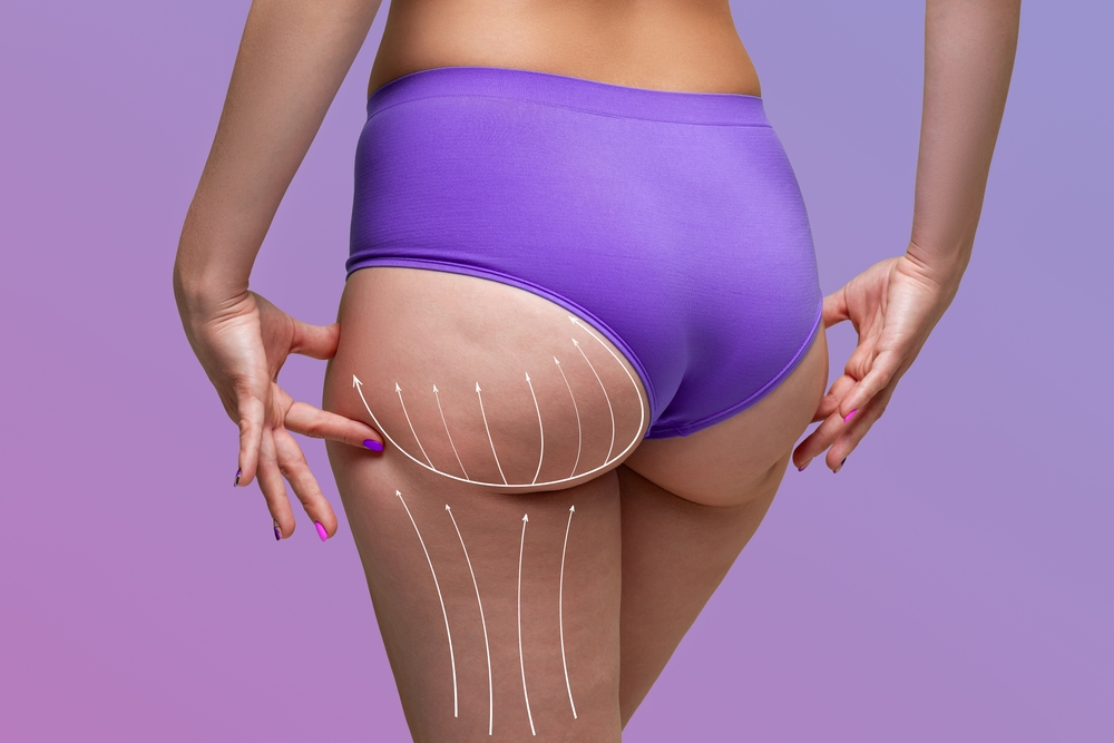 How to Achieve the Best Brazilian Butt Lift Results in Alexandria, VA