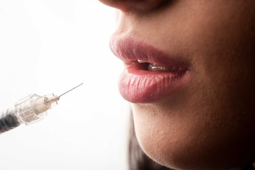 Getting the Best Lip Filler Results in Alexandria VA
