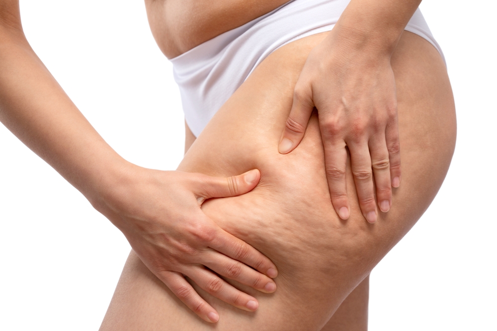 Cellulite Treatments in Alexandria VA