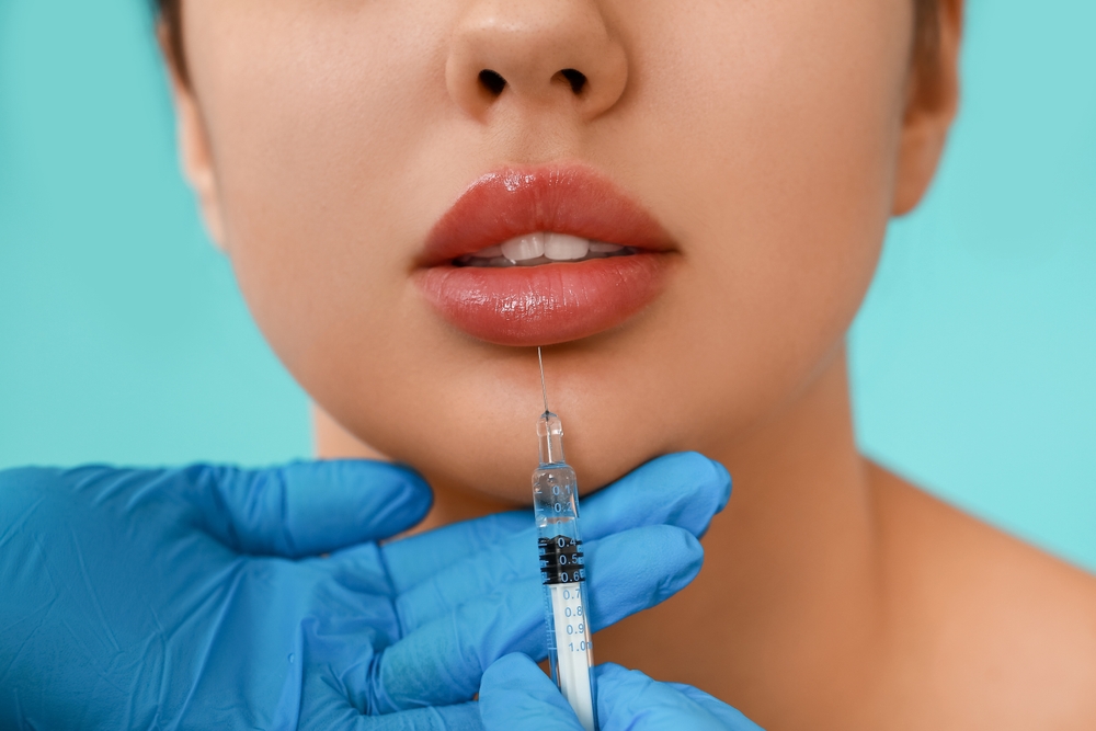 Best Lip Filler Results In Alexandria, VA: Before and After Lip Injections