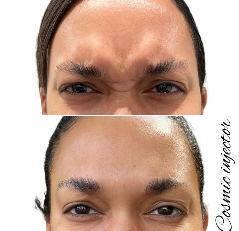 botox-before-after-cosmic-injector