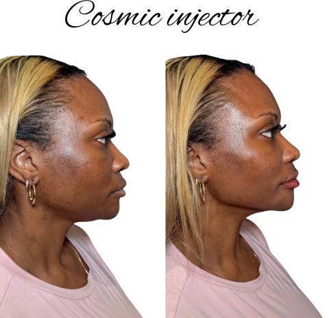 jaw-contouring-before-after-cosmic-injector