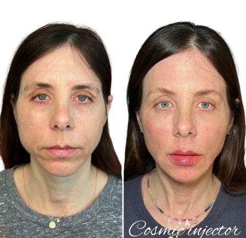 jaw-filler-before-after-cosmic-injector