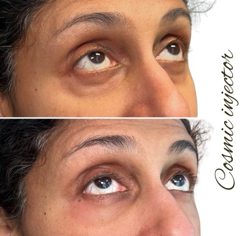 under-eye-filler-before-after-cosmic-injector